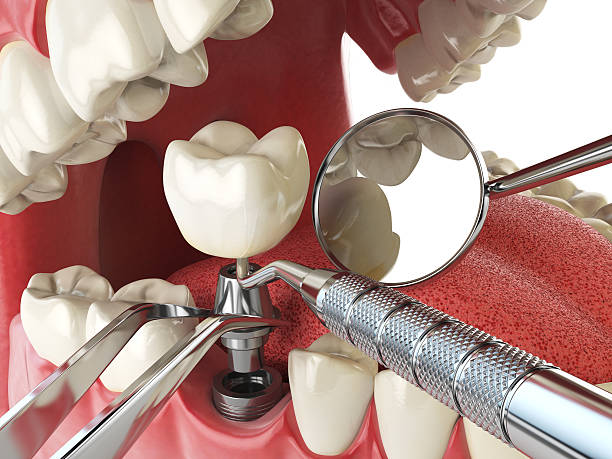 Best Emergency Dental Extractions in Fulton, MO